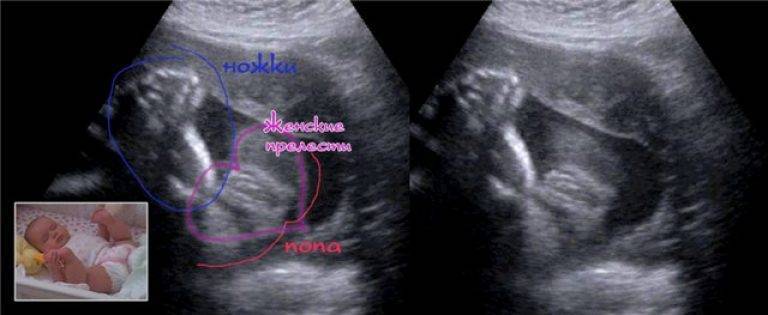 Девочки и мальчики на узи при беременности: как выглядит различие по полу?