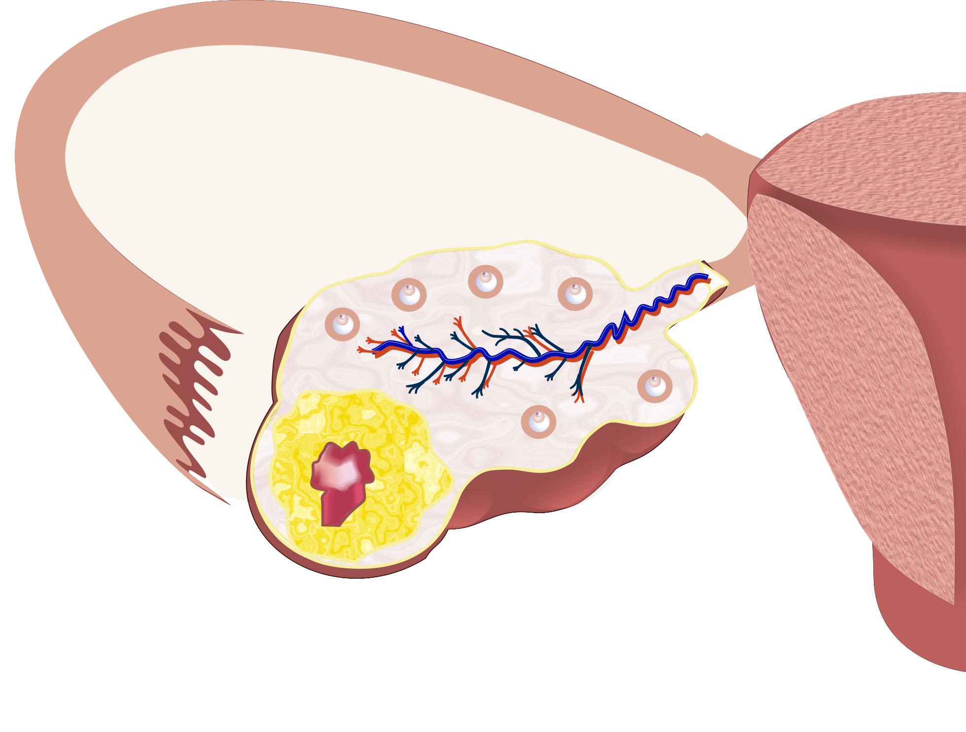 Удаление яичника можно забеременеть после. Лютеиновые кисты яичника. Лютеиновая киста яичника. Киста желтого тела яичника. Персистемное желтое тело яичника..