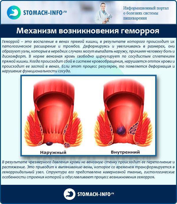 Геморрой симптомы и лечение у женщин причины возникновения картинки