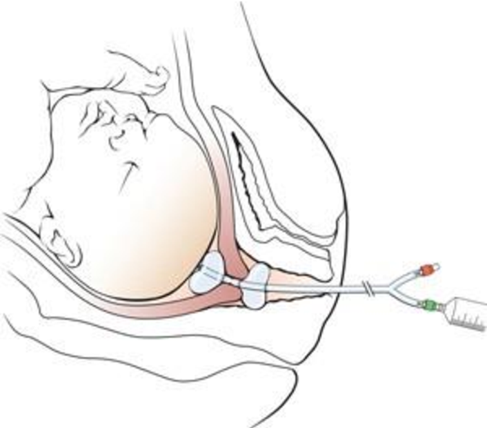 Катетер фолея для стимуляции родов: установка для стимуляции, последствия и осложнения