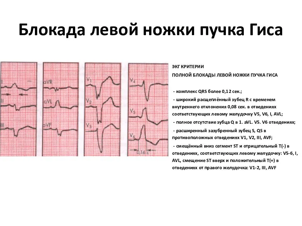 Блокада гиса на экг. ЭКГ критерии блокады левой ножки пучка Гиса. ЭКГ признаки блокады левой ножки пучка. Неполная блокада левой ножки ЭКГ критерии. Блокада левой ножки пучка Гиса на ЭКГ.