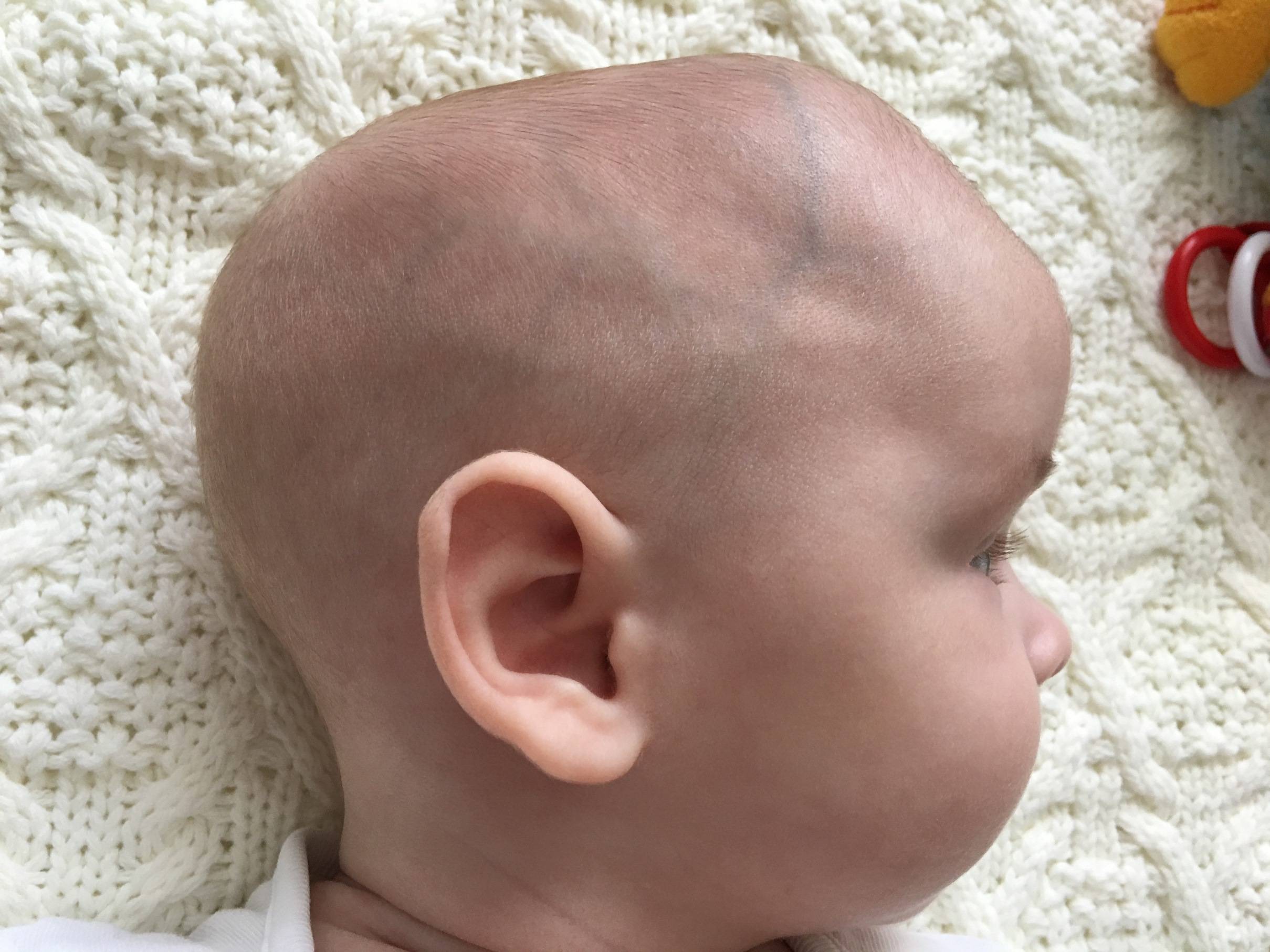Уменьшение окружности головы (микрокрания) у ребенка
