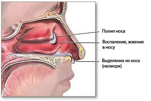 Отек слизистой носа у ребенка ‒ что делать?