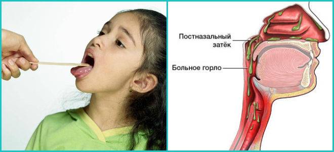 Кашель от соплей у ребенка: чем лечить и как остановить стекание по задней стенке горла