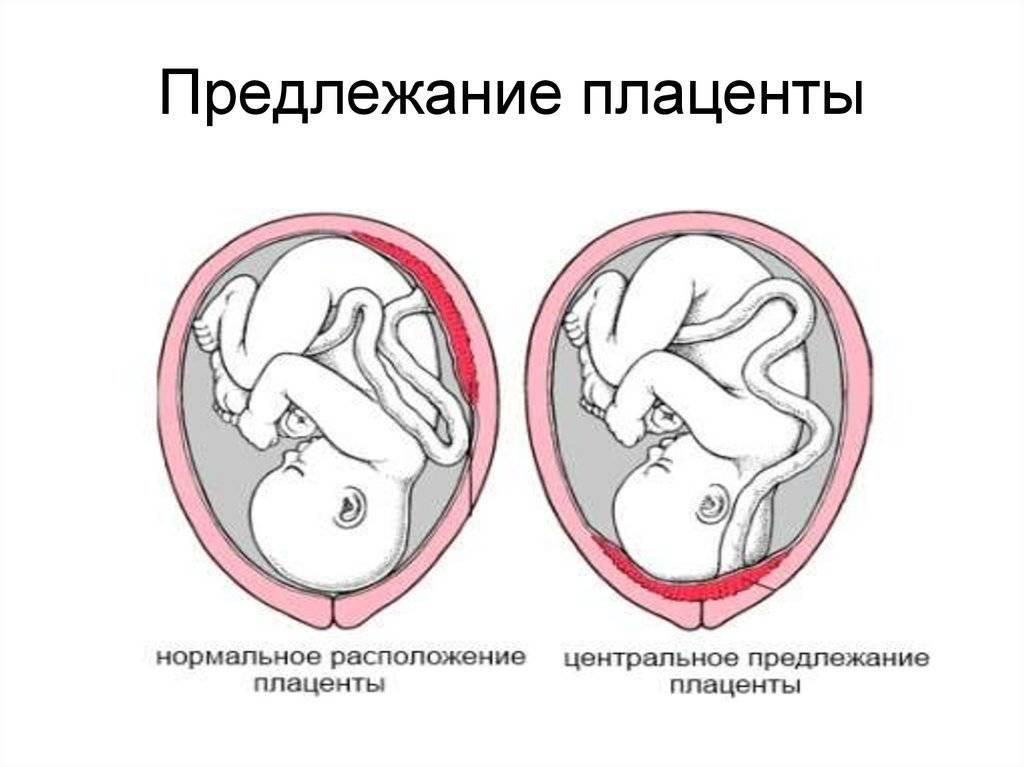 Низкая плацентация при беременности