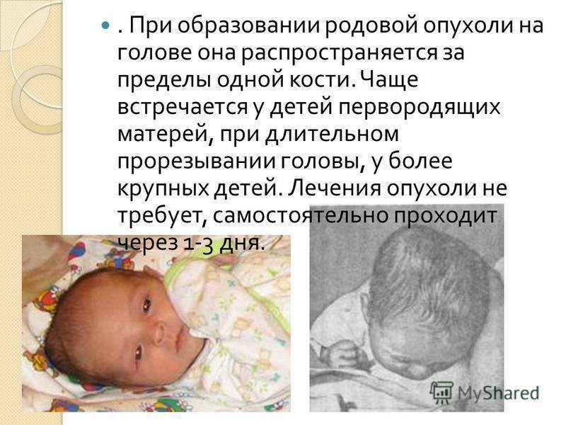 Кефалогематома у новорожденных на голове: последствия, лечение, пункция (фото)