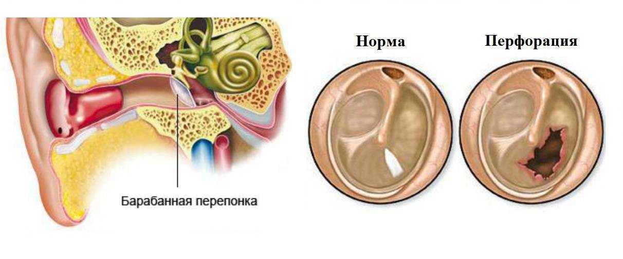 Шунтирование барабанной полости