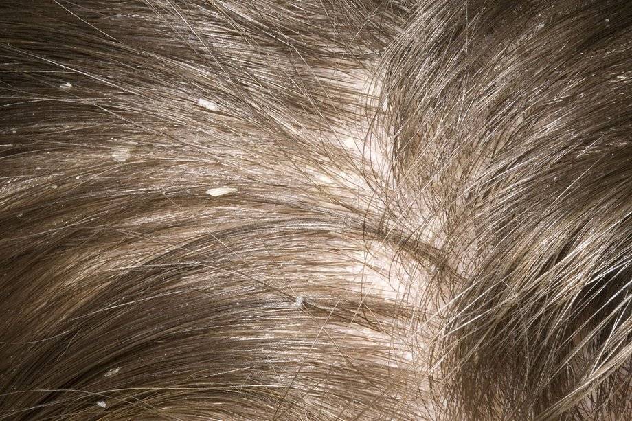 Виды перхоти на голове - клиника «доктор волос»