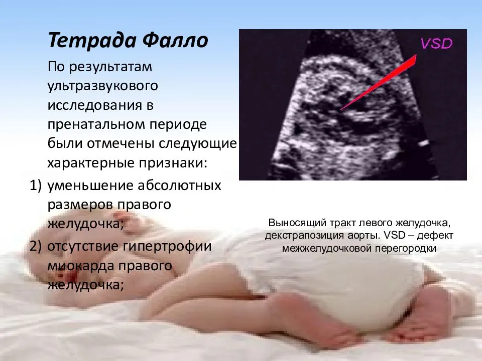 Порок сердца у плода: диагностическое узи во время беременности, причины и лечение