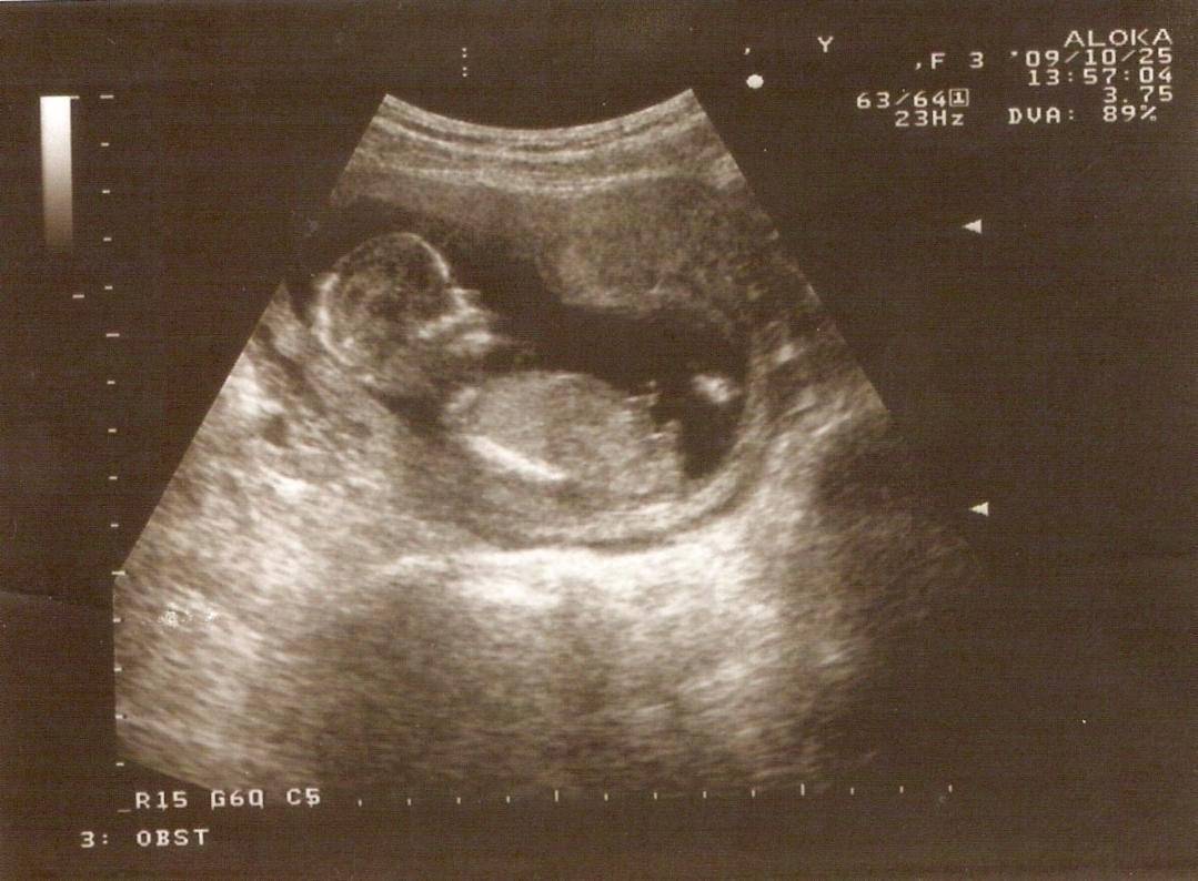 Роды 15 недель. УЗИ ребенка на 15 неделе беременности фото плода. УЗИ плода 15 акушерских недель беременности. Плод ребенка на 15 неделе беременности. Плод 15 недель беременности размер плода.