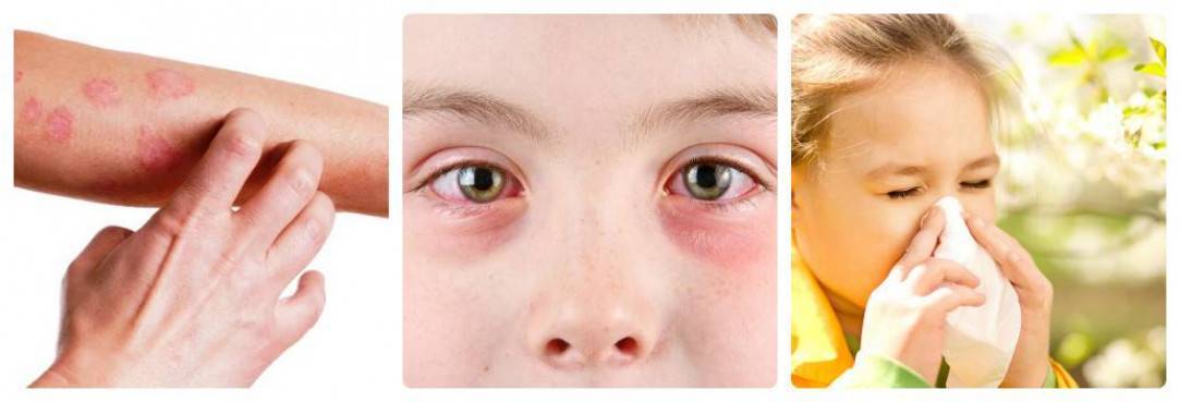 Ложная аллергия — причины, симптомы, диагностика и лечение псевдоаллергии
