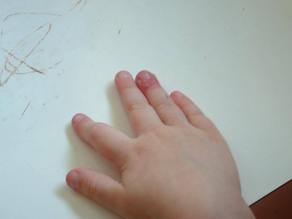 Гнойная рана у ребенка — лечение открытого нарыва у грудничка (на пальце), первая помощь