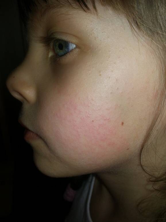 Аллергия на коже лица: виды аллергической сыпи у взрослого, лечение и фото, чем лечить, снять реакцию, что делать с прыщами, как убрать и избавиться, причины сильных высыпаний на шее