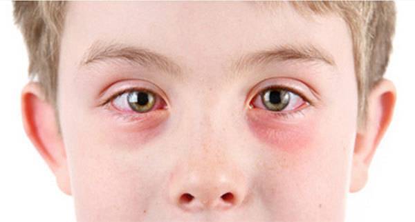 Лечение аллергического конъюнктивита у взрослых и детей
