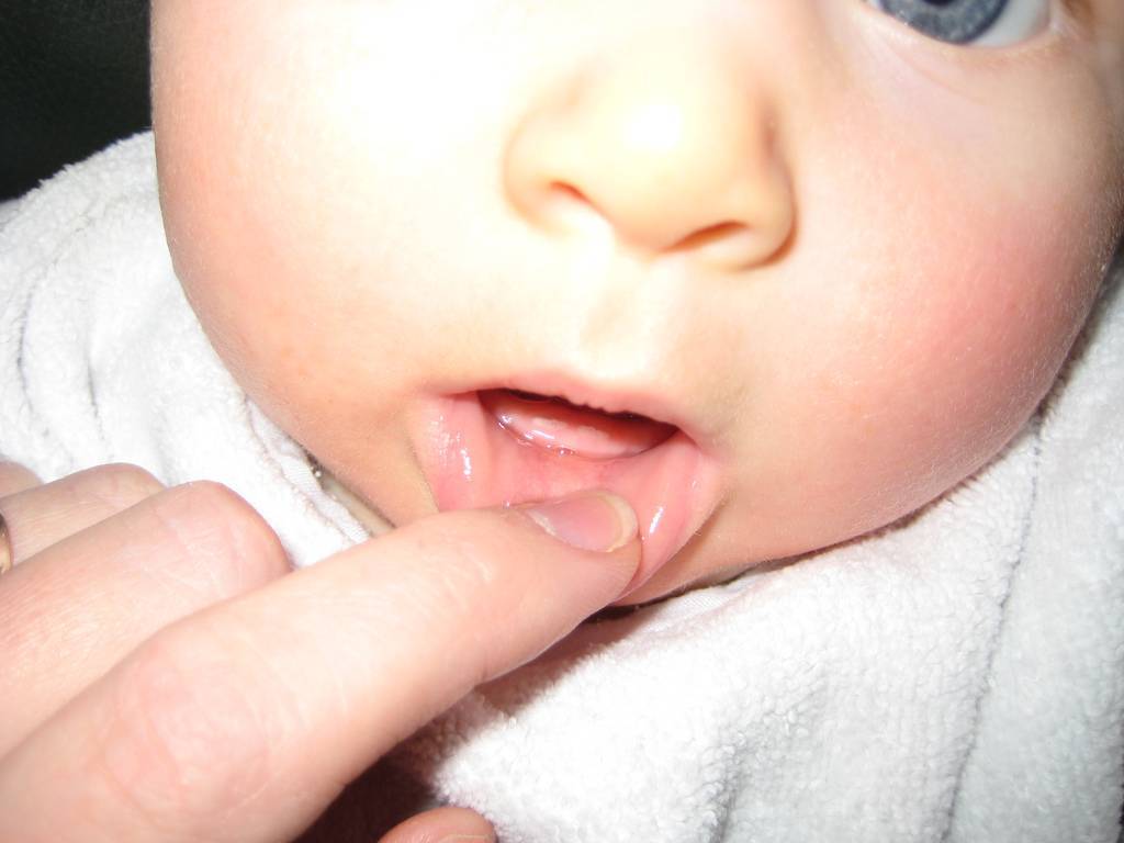 Прорезывание зубов у ребенка: симптоматика