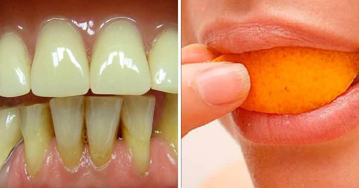 Зубной налёт, его причины и виды | стоимость удаления зубного налёта