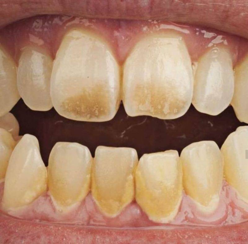 Зубной налет — почему образуется и как удалять