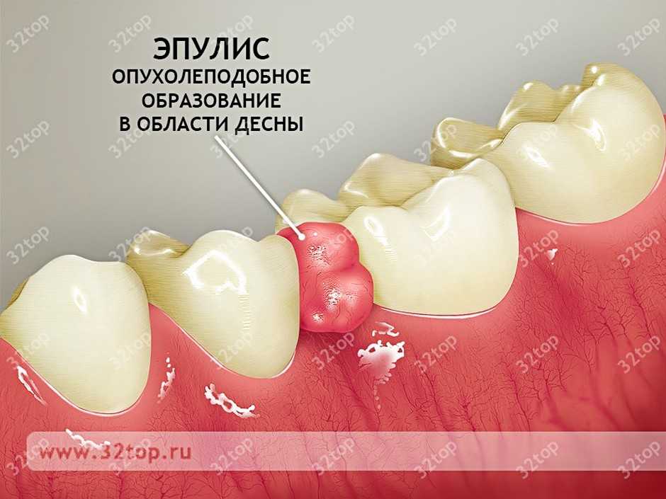 Гнойник на десне у ребенка: лечение, симптомы, лечение в домашних условиях