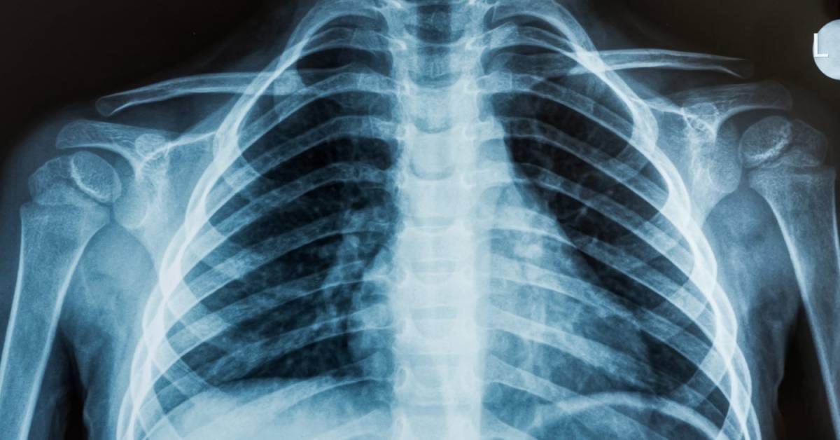 Рентген при туберкулезе - симптомы, признаки, описание рентгена при пневмонии :: polismed.com