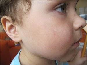 Увеличенные миндалины у ребенка - о чем свидетельствуют?