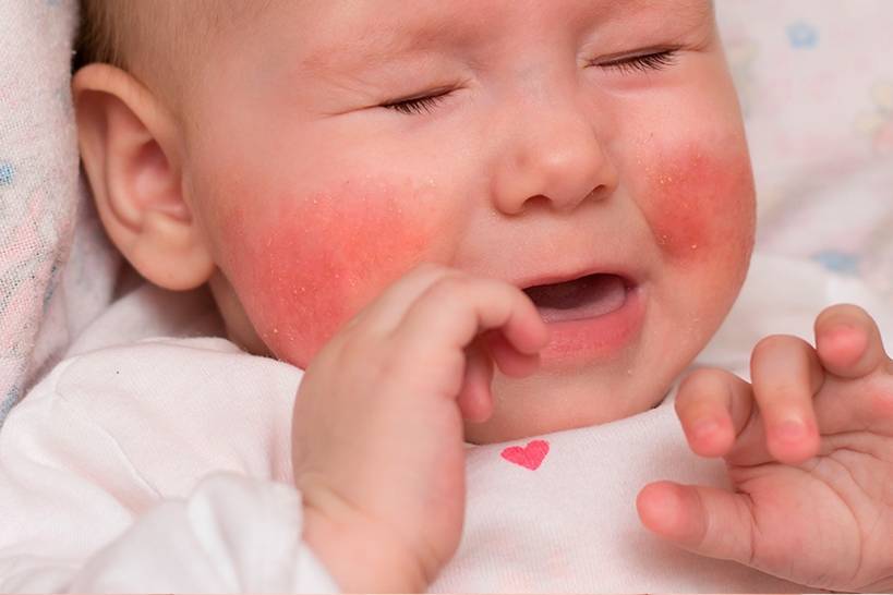 Аллергия у новорожденного на смесь | как проявляется аллергия при грудном вскармливании | nutrilak