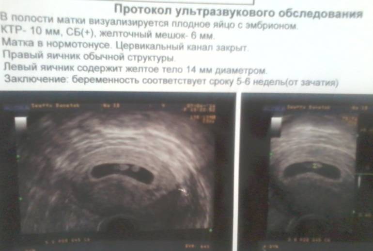 6 недель будет виден. Плодное яйцо на УЗИ 3 недели беременности. УЗИ беременности плодное яйцо 4 недели. УЗИ 6 недель беременности плодное яйцо на УЗИ. УЗИ беременности 8-9 недель плодное яйцо.