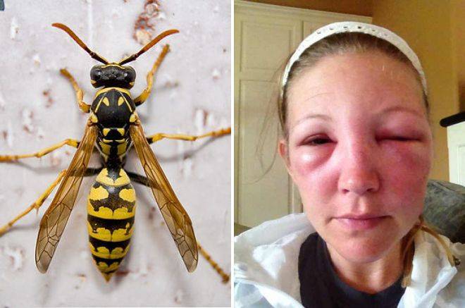 Аллергия на укусы насекомых. типы аллергических реакций. умеренная и острая  аллергия. что делать при укусе насекомых?