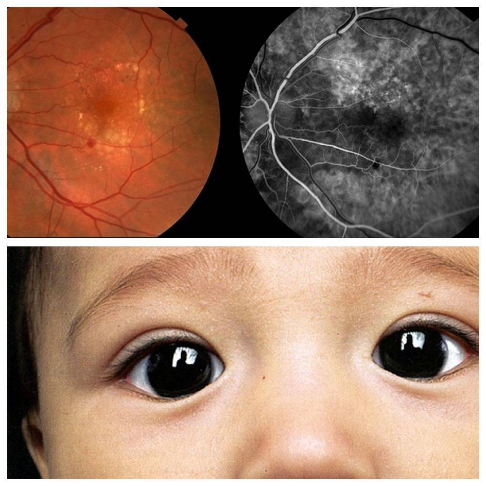 Ангиопатия сетчатки глаза: диагностика и лечение | клиника санта