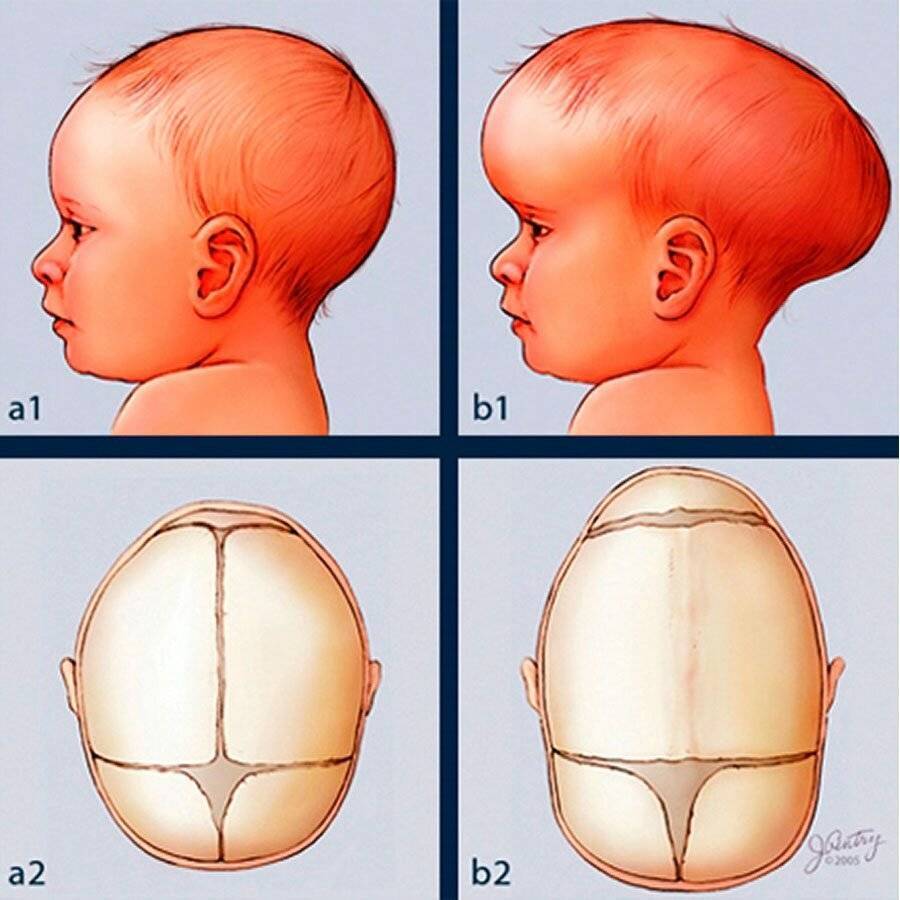 4 хитрости помогут предотвратить синдром плоской головы у младенца