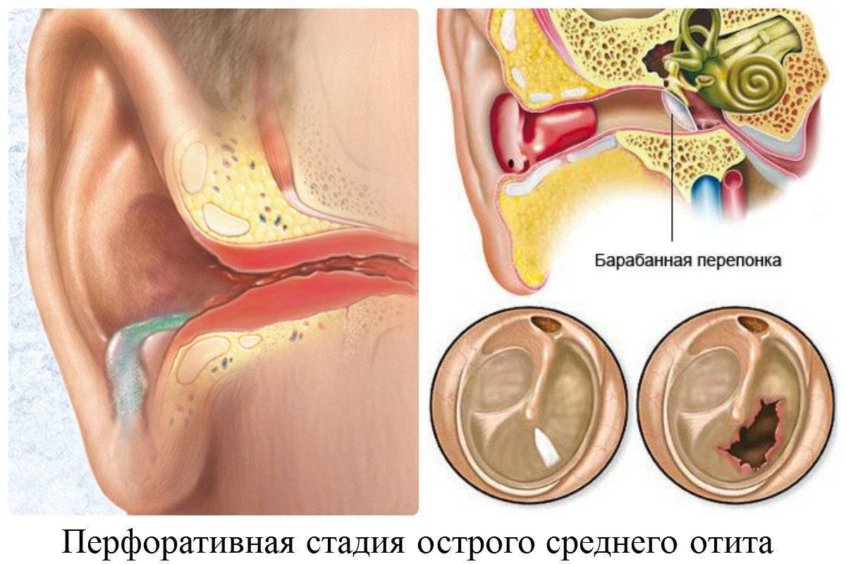 Отит у ребенка картинки