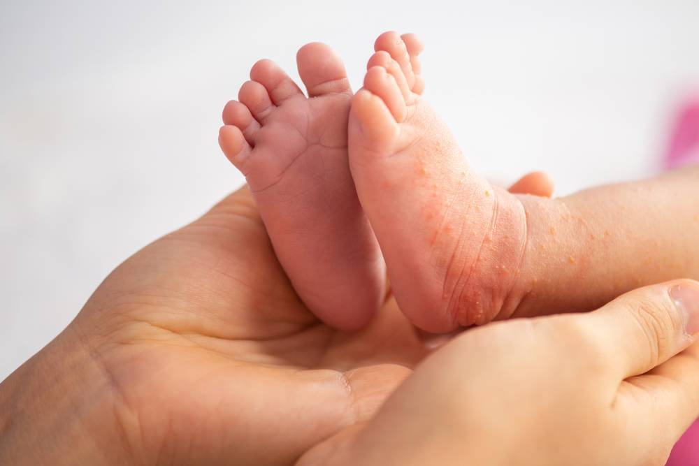 Опрелости у новорожденных: чем и как лечить