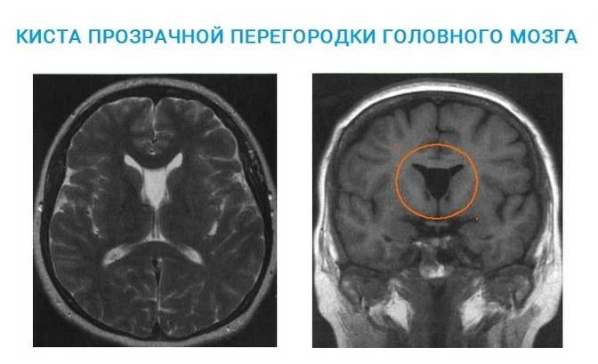 Нейросонография – ультразвуковое сканирование головного мозга