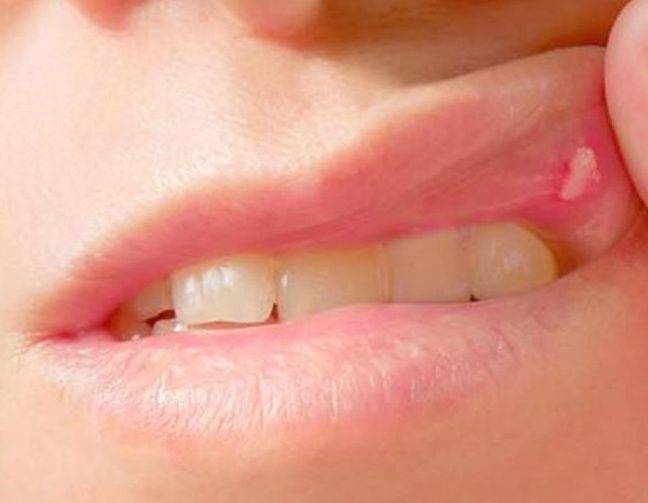 Влияние covid-19 на полость рта | стоматология элитдентал м.