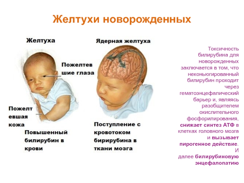 Желтуха у новорожденных: причины и все способы лечения