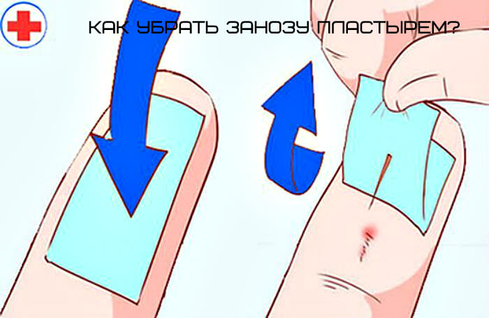 Что делать, если у ребенка заноза? как удалить занозу без боли
