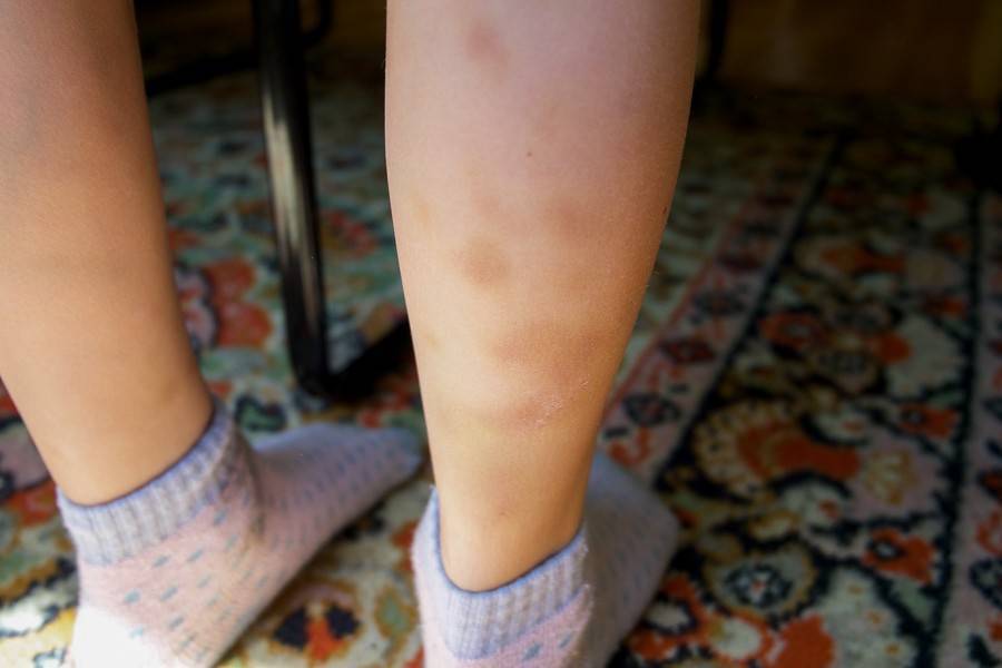 Синяки на ногах у ребенка без причины - что это и почему постоянно появляются пятна?