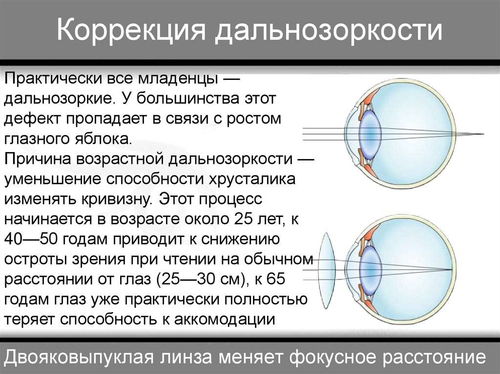 Гиперметропия ???? информационный портал детское зрение