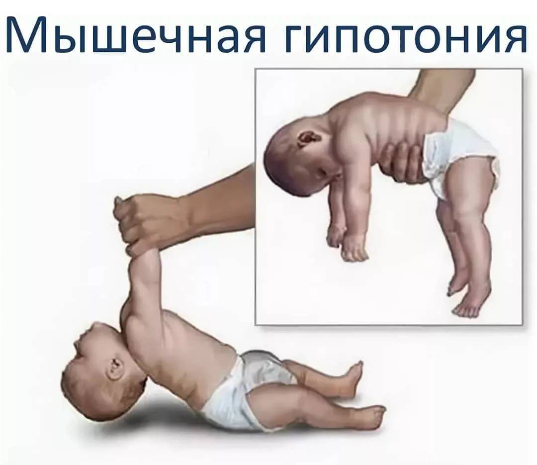Тонус мышц ребенка и его нарушения   | материнство - беременность, роды, питание, воспитание
