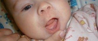Прорезывание зубов у детей: фото десны у грудничков при воспалении и набухании