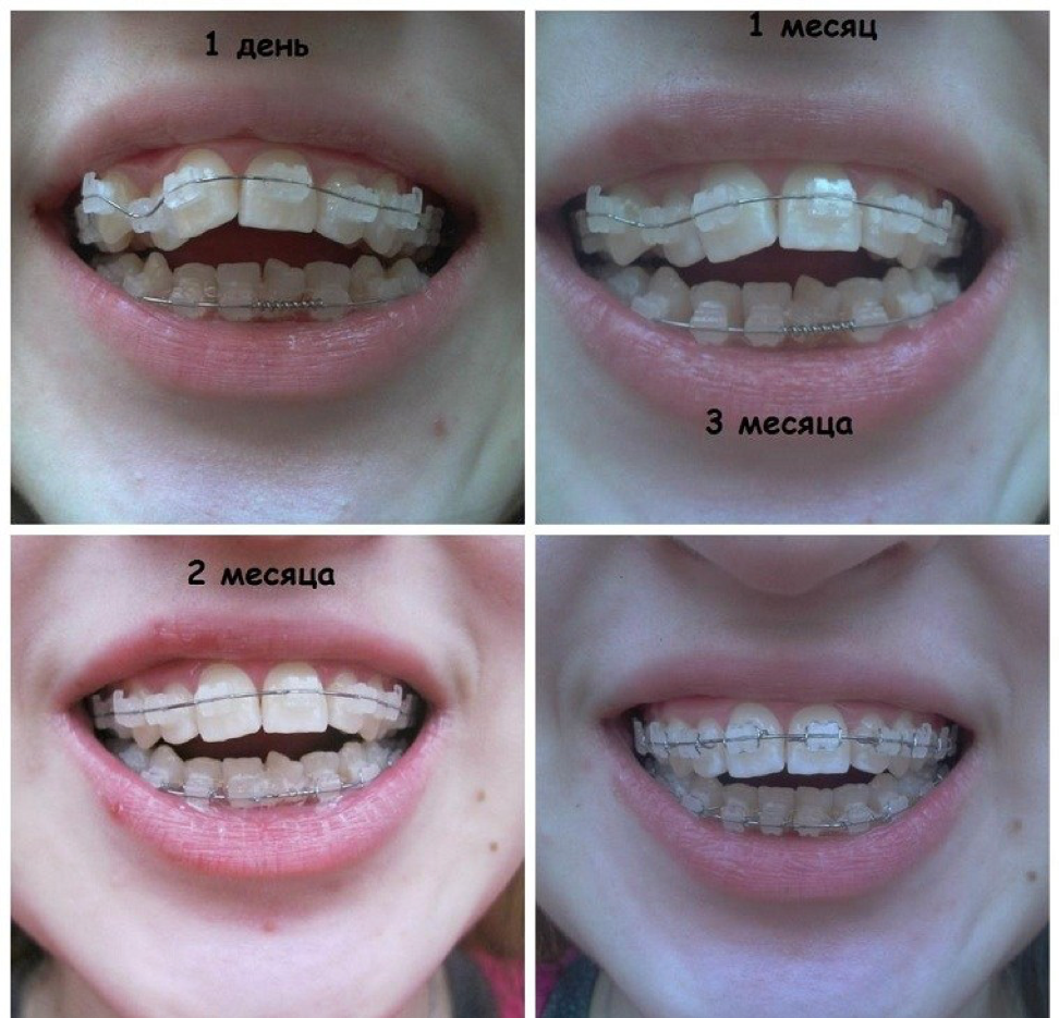 Исправление зубов брекетами. Брекеты до и после зубы прикус. Меняются передние зубы