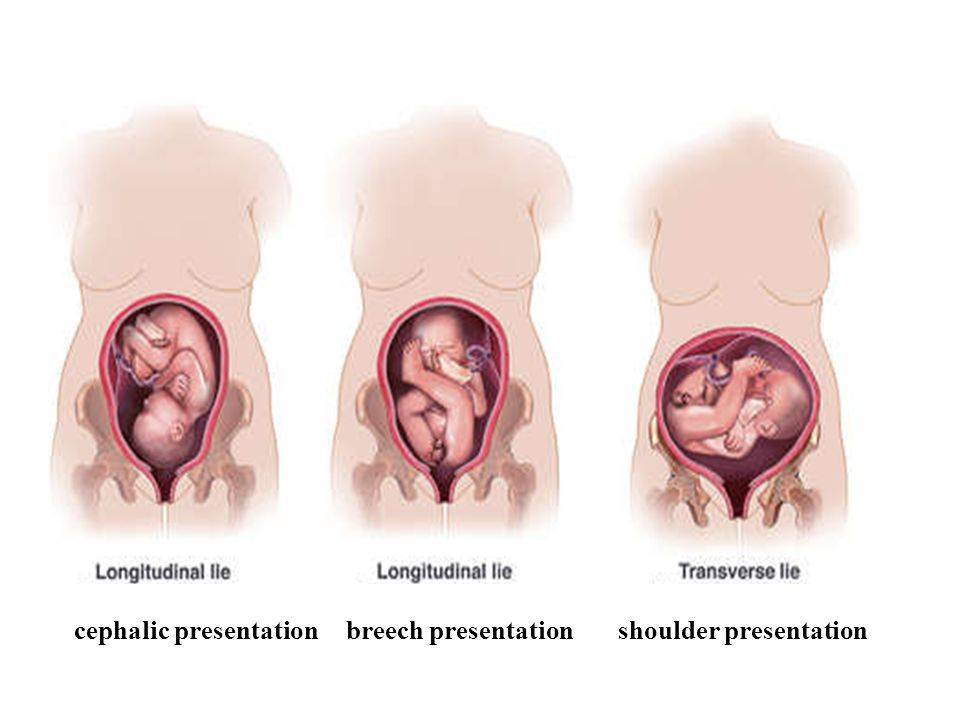 Поперечное предлежание (положение) плода при беременности: что это значит, если ребенок лежит поперек в животе