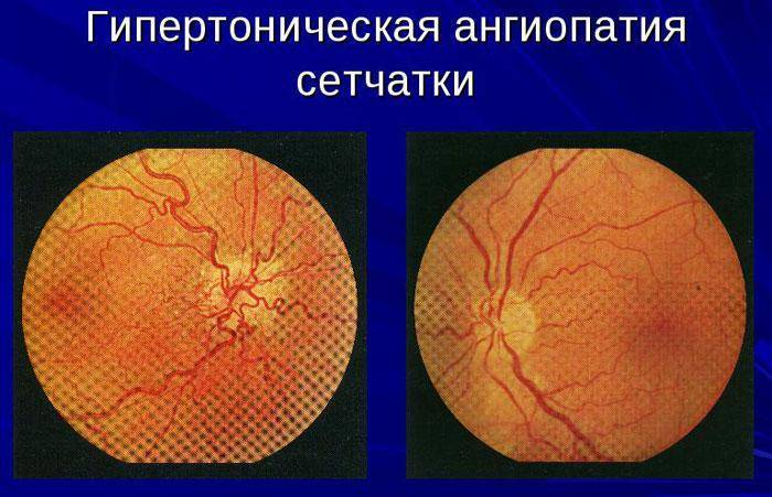 Ангиопатия сетчатки глаза у ребенка и ее лечение