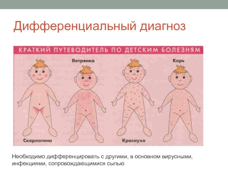 Розеола у малышей: причины инфекции и лечение