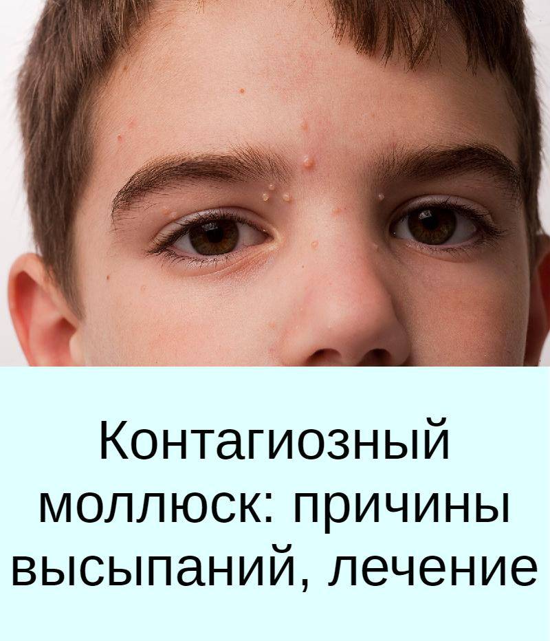 Контагиозный моллюск: симптомы и лечение