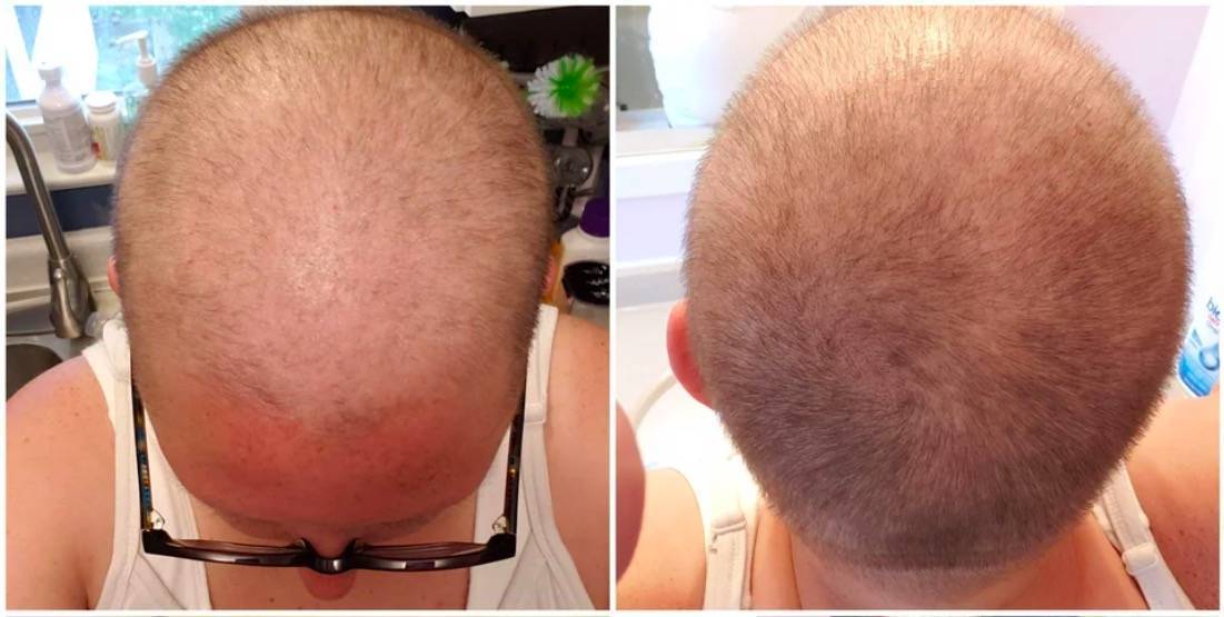 После лучевой волосы выпадают. Выпадение волос после химиотерапии. Прическа после химиотерапии. Волосы после химии терапии. Рост волос после химиотерапии.