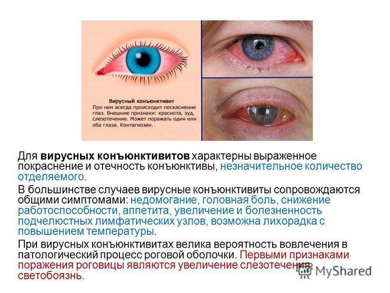 Болезни глаз - список заболеваний и их симптомы