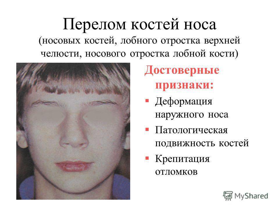 Перелом носа у ребенка: симптомы и признаки с фото, способы определения травмы