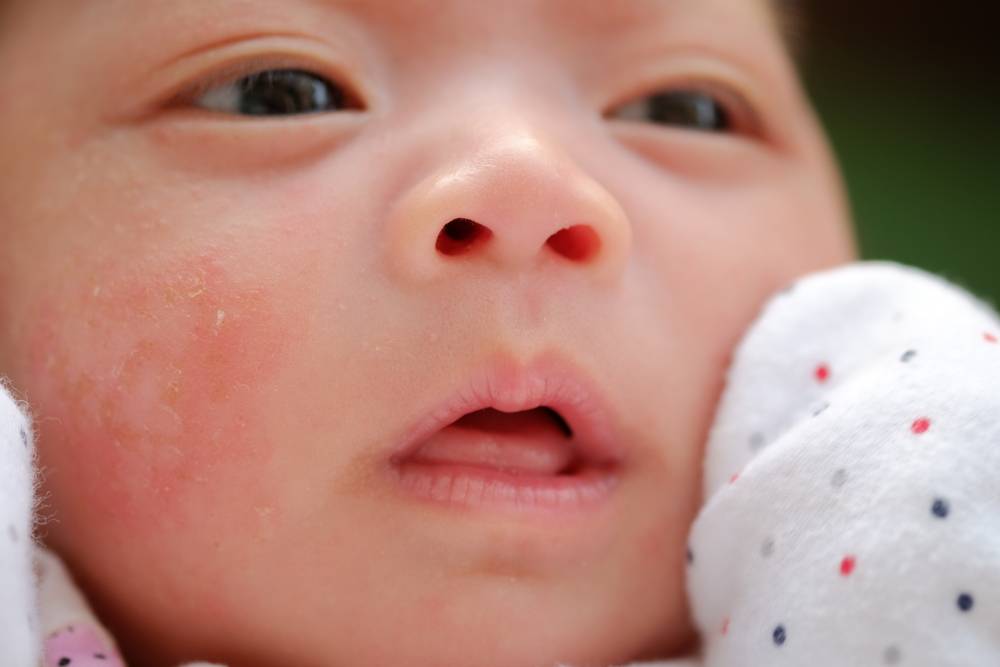 Аллергия на щеках у новорожденного