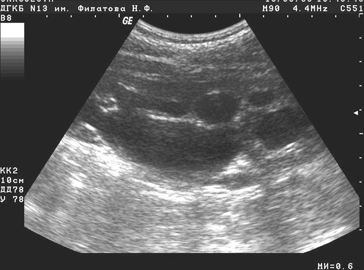 Пиелонефрит при беременности | особенности пиелонефрита почек у беременных