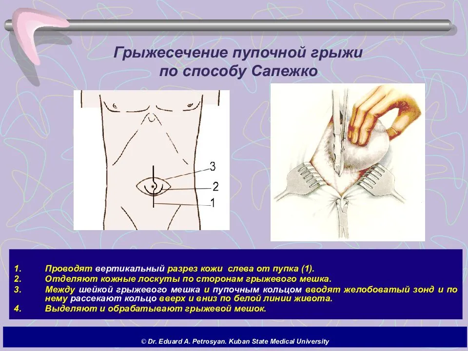 План обследования при пупочной грыже